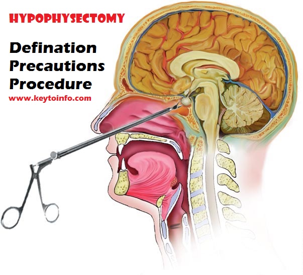 Hypophysectomy : Definition, Precautions and Procedure