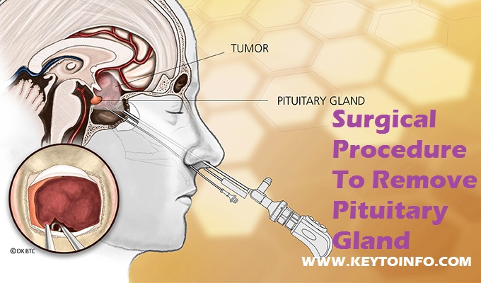 Surgical Procedure To Remove Pituitary Gland