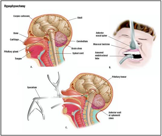 What is Transsphenoidal Hypophysectomy
