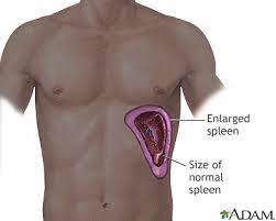 Is An Enlarged Spleen Is Serious ?