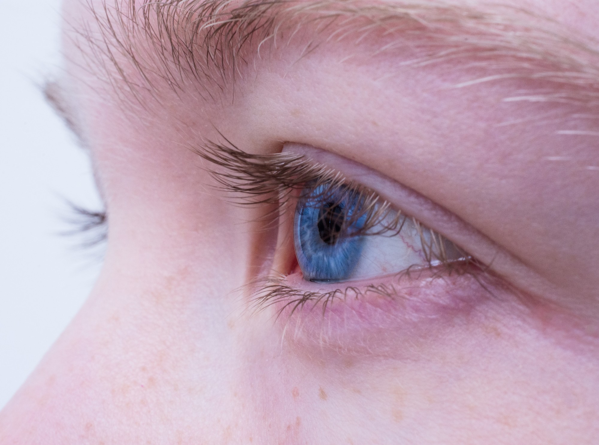 7 Tips for Preventing Droopy Eyelids