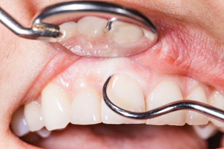 What Do Dental Gum Measurements Mean?