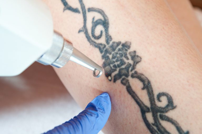What to Expect After Laser Tattoo Removal