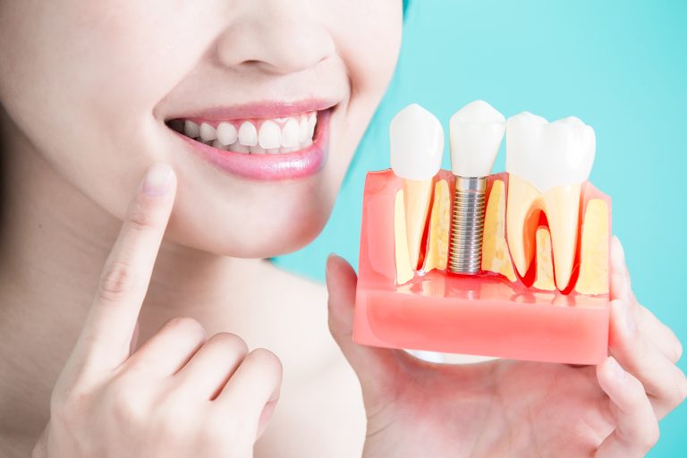 4 Signs You May Need Dental Implants