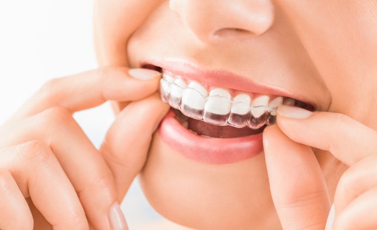 5 Benefits of Invisalign for You to Consider