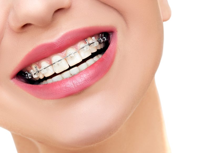 4 Things to Know About Getting Braces