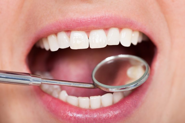 Shining Bright: Is Opting for Gold Dental Fillings a Good Idea?