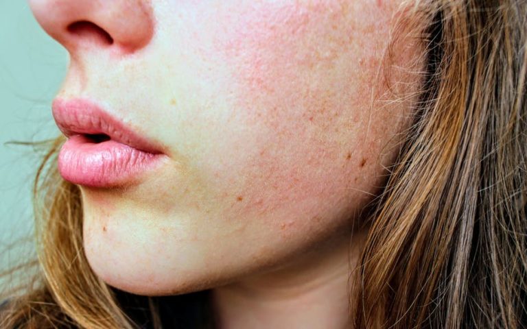 Can Stress Cause Skin Problems?