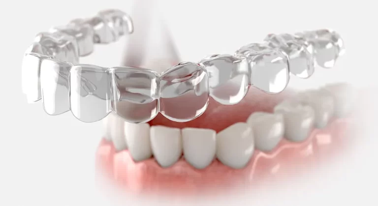 Experience the Benefits of Invisalign: Straight Teeth without Traditional Braces
